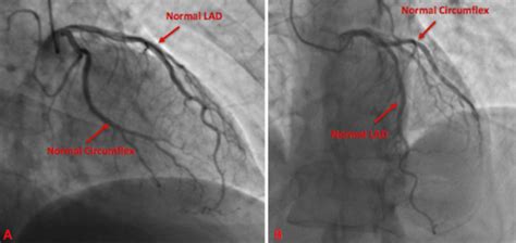 left heart catheterization without grafts